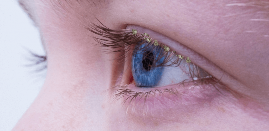 blepharitis treatment